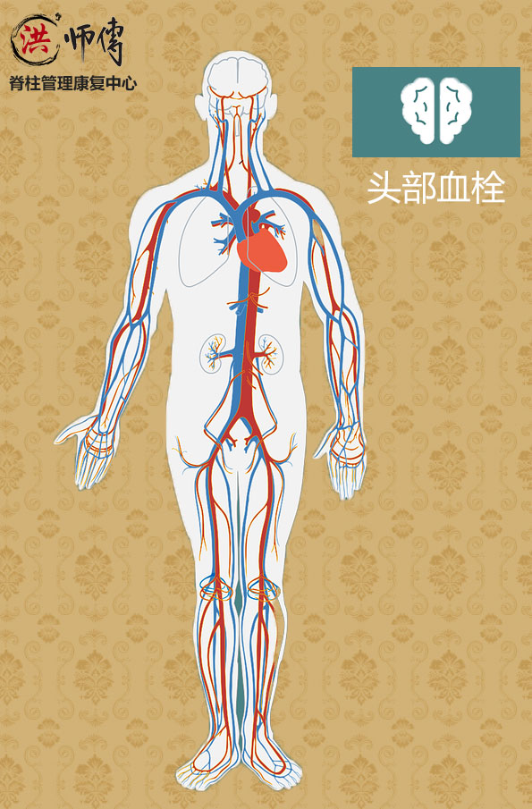 头部血栓